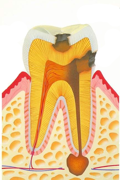 虫歯.jpg
