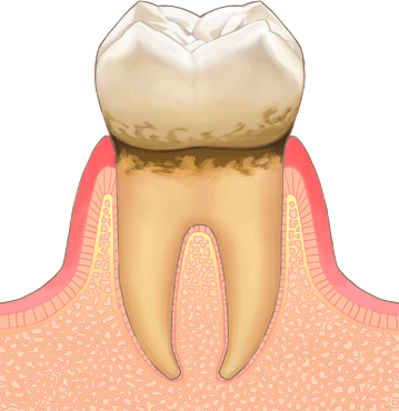 歯周病・ステージ 1