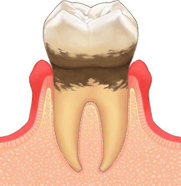 歯周病・ステージ 2