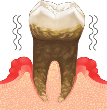 歯周病・ステージ 4