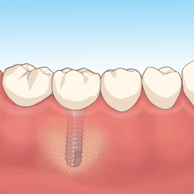 インプラント2.gif