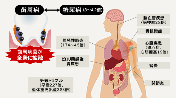 糖尿病（3～4.2倍）、誤嚥性肺炎（1.74～4.5倍）、ピロリ菌感染胃疾患、妊娠トラブル（早産2.27倍、低体重児出産2.83倍）、脳血管疾患（脳梗塞2.8倍）、骨粗鬆症、心臓疾患（狭心症、心筋梗塞1.9倍）、腎炎、関節炎