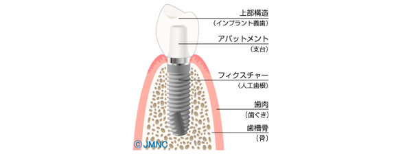 インプラントの構造（イメージ）