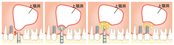 ソケットリフト（イメージ）