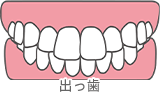 出っ歯