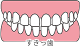 すきっ歯