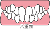ガタガタ・八重歯（上下）
