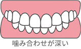 噛み合わせが深い