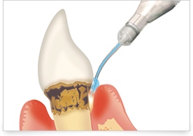 ペリオウェーブ（レーザー治療）