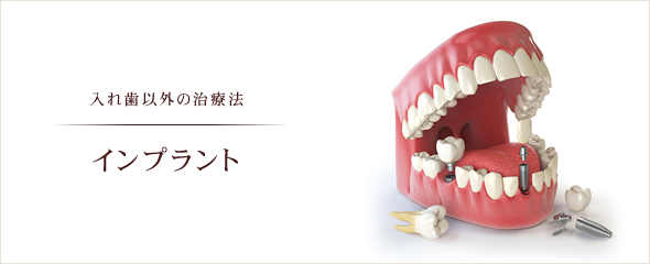 入れ歯以外の治療法 インプラント