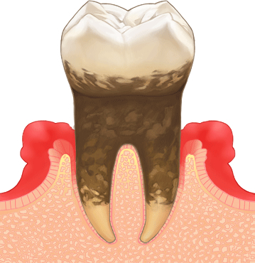 歯周病・ステージ 3