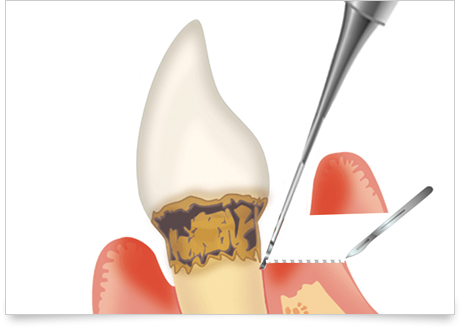 歯周外科治療